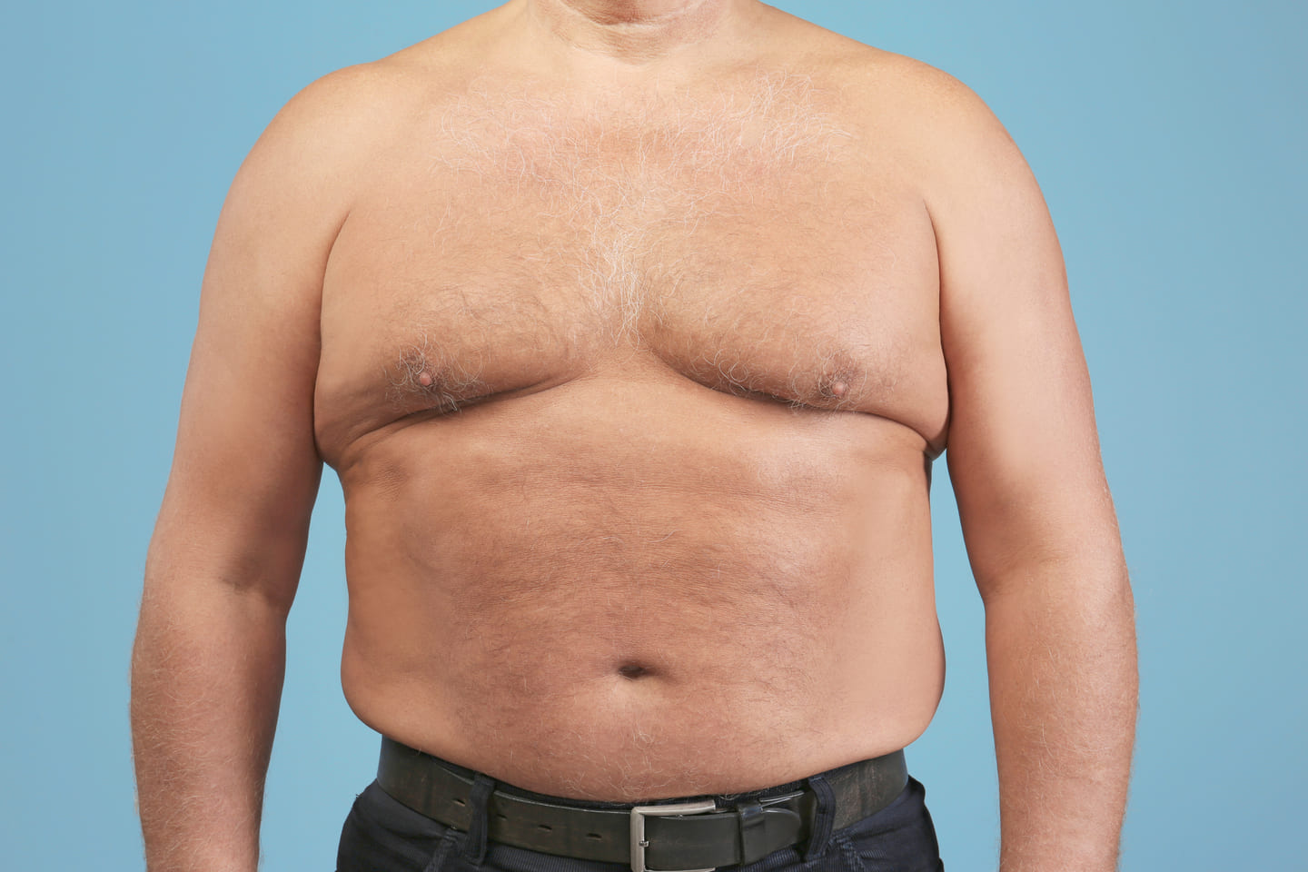 Ginecomastia é diagnóstico de exame físico, não de estradiol alto no laudo. Quando a conduta clínica resolve e quando só a cirurgia resolve.